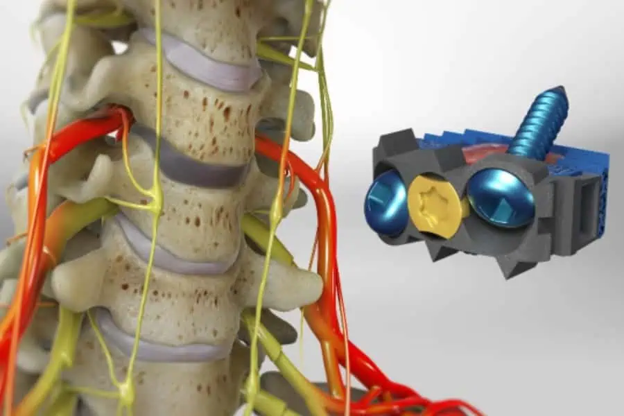 arthrodese cervicale chirurgie du rachis espace francilien du rachis clinique du rachis versailles paris