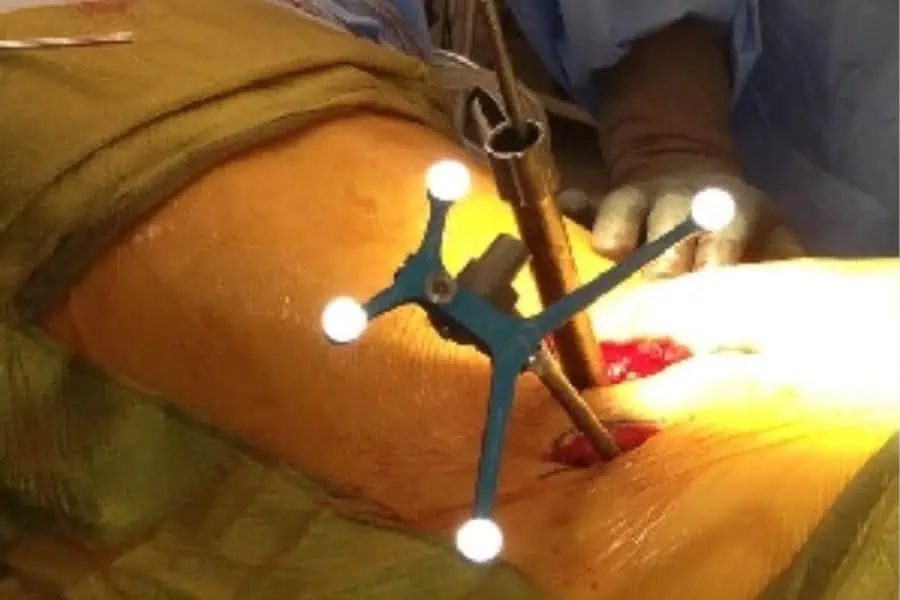 arthrodese lombaire chirurgie du rachis espace francilien du rachis clinique du rachis versailles paris