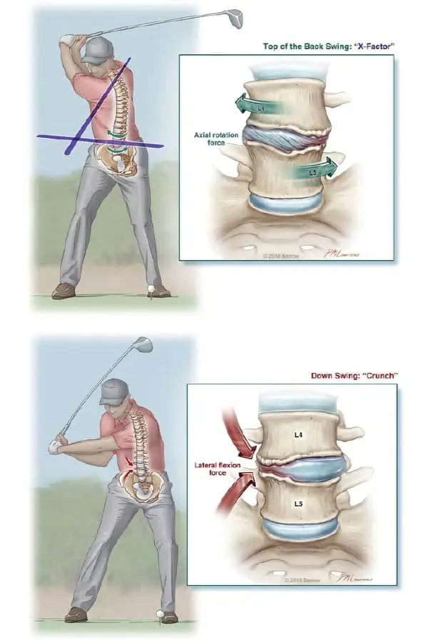 golf effets colonne vertebrale chirurgie du rachis espace francilien du rachis clinique du rachis versailles paris