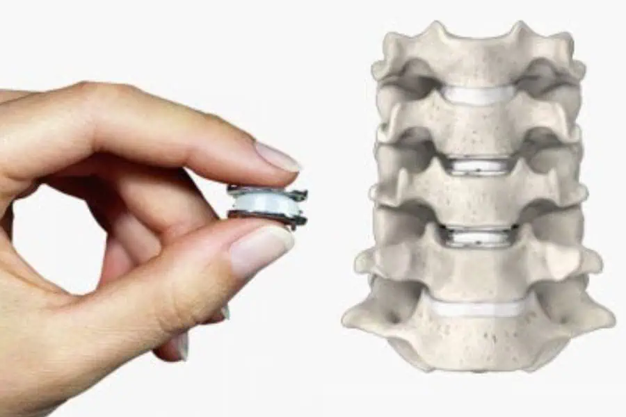 prothese discale cervicale chirurgie du rachis espace francilien du rachis clinique du rachis versailles paris