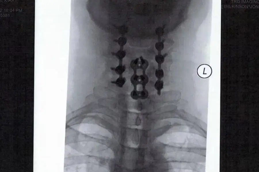 radiographies jonny wilkinson rachis cervical chirurgie du rachis espace francilien du rachis clinique du rachis versailles paris